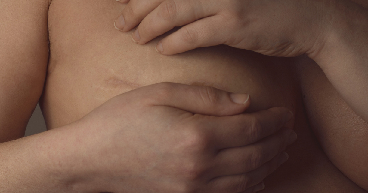 Soulager les effets secondaires du Cancer du Sein grâce à la Médecine Traditionnelle Chinoise